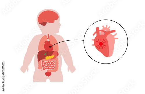 Heart disease in a child