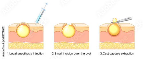 Sebaceous Cyst Removal