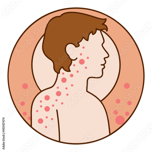 Person with red allergic rash on back illustration