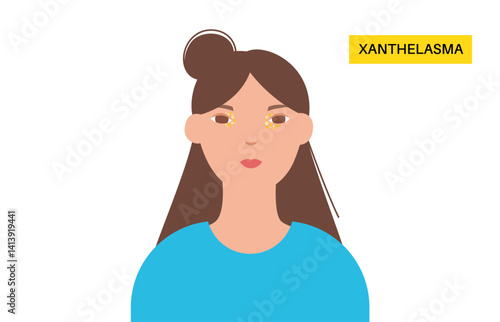 Xanthelasma skin disease