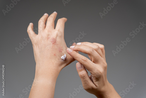 Applying cream woman's hand. Apply topical steroids, medical concept.