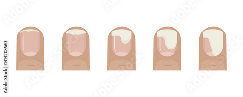 Onycholysis stages showing nail separating from nail bed