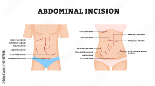 Abdominal Incision for man and woman, educational medical poster design healthcare scheme, labeled Surgical Cut in Abdomen for Medical Procedure, Anatomy, Laparotomy, Surgery Education