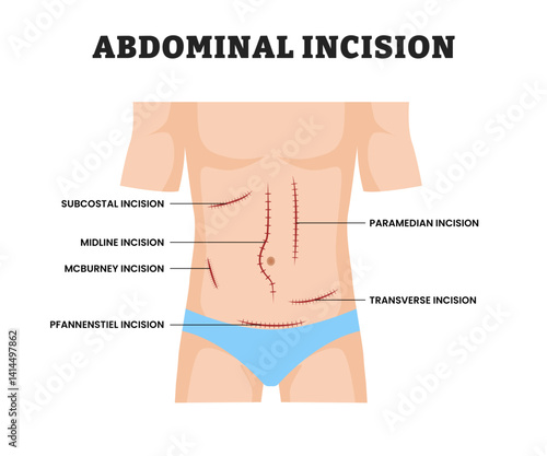 Abdominal Incision for man, educational medical poster design healthcare scheme, labeled Surgical Cut in Abdomen for Medical Procedure, Anatomy, Laparotomy, Surgery Education