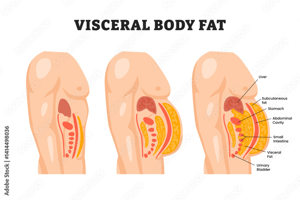 Visceral fat, educational medical poster design healthcare scheme, labeled abdominal fat surrounds the inner doors of the abdominal cavity. Overweight disease concept, Weight loss, liposuction, diet. Visceral fat, educational medical poster design healthcare scheme, labeled abdominal fat surrounds the inner doors of the abdominal cavity. Overweight disease concept, Weight loss, liposuction, diet.
