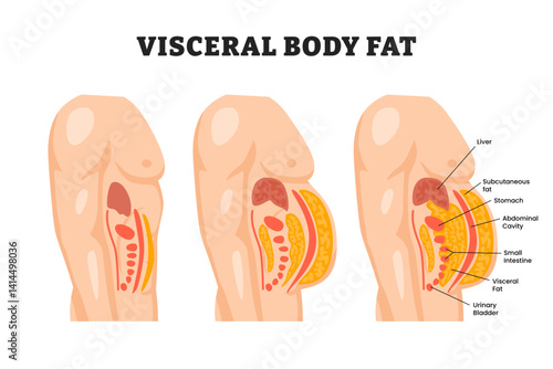 Visceral fat, educational medical poster design healthcare scheme, labeled abdominal fat surrounds the inner doors of the abdominal cavity. Overweight disease concept, Weight loss, liposuction, diet.