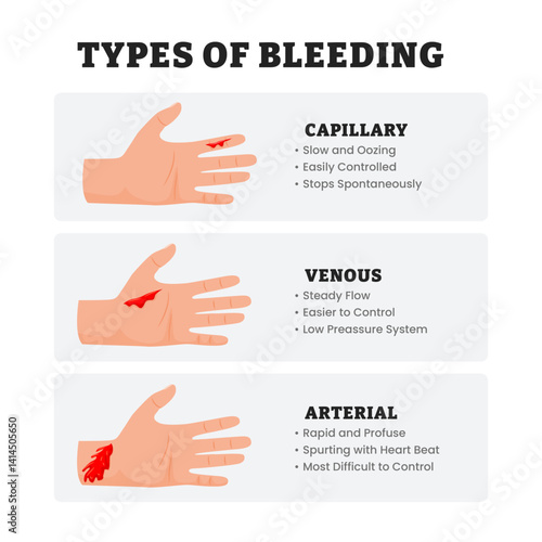 Different types of various bleeding types in hand gesture, educational medical poster design healthcare scheme, labeled capillary, venous, arterial. External Bleeding Hemorrhage Classification.