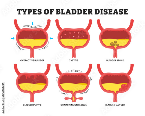 Different types of various bladder disease types, educational medical poster design healthcare scheme, labeled overactive bladder, cystitis, bladder stone, polyps, urinary incontinence, bladder cancer