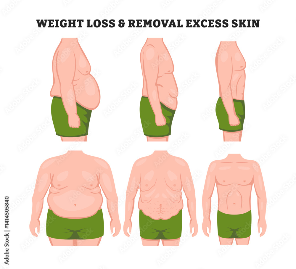 Ταπετσαρία Human body problem after Weight loss, excess skin removal in man with front and side view, educational medical poster design healthcare scheme, labeled Advertising of cosmetic plastic procedures