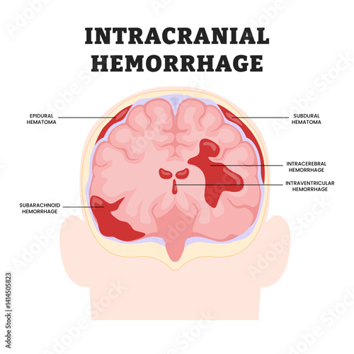 Set of various Intracranial Hemorrhage types, educational medical poster design healthcare scheme, labeled epidural and subdural, hematoma, subarachnoid hemorrhage, intracerebral, intraventricular.