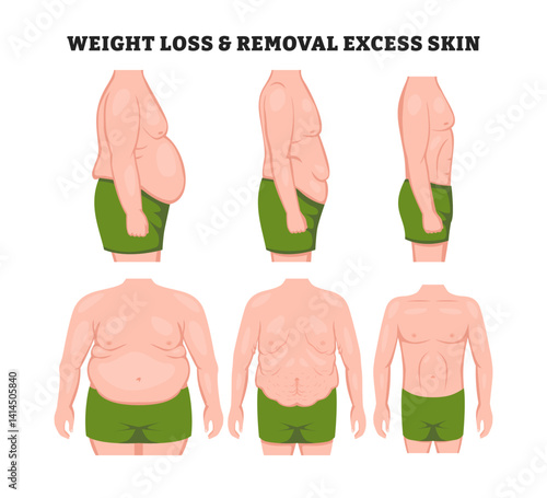 Human body problem after Weight loss, excess skin removal in man with front and side view, educational medical poster design healthcare scheme, labeled Advertising of cosmetic plastic procedures.