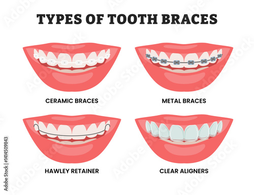 Different types of tooth braces tooh, educational medical poster design healthcare scheme, labeled ceramic braces, metal braces, hawley retainer and clear aligner. Tooth mouth, orthodontic dentist.