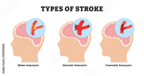 Different types of stroke types, educational medical poster design healthcare scheme, interrupted blood flow human brain blockage, labeled blister aneurysm, saccular aneurysm, traumatic aneurysm.
