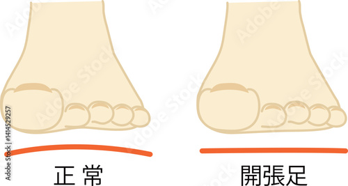 正常な足先と開張足のイラスト