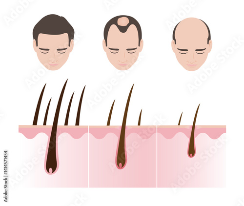 Step of male pattern hair loss vector illustration isolated on white background. The man with stages of hair losing with scalp layer anatomy. Androgenetic alopecia, male pattern baldness.