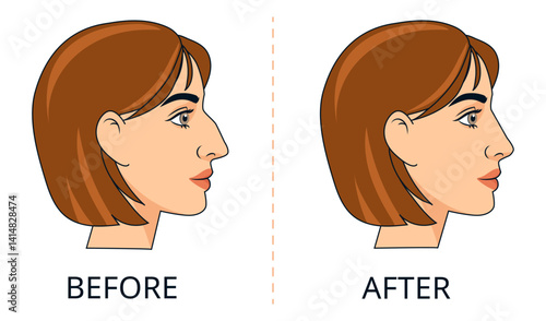 Female Rhinoplasty Before and After Vector Illustration. Plastic surgery infographics. Comparison of a womans side profile before and after rhinoplasty surgery, medical presentations, cosmetic clinic