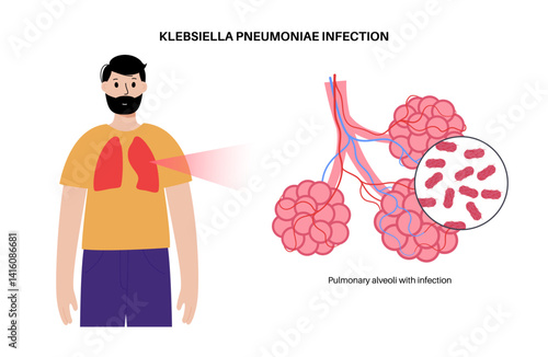 Klebsiella pneumoniae poster