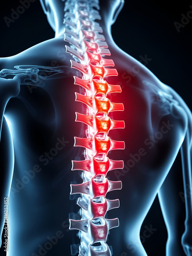 Close-up of a human spine with emphasis on a herniated disc causing back pain