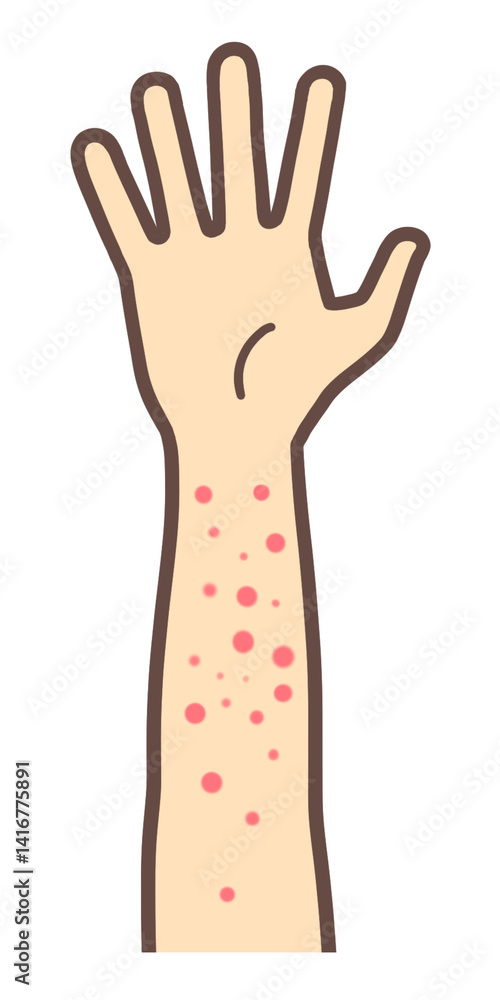 Fototapeta premium 赤い湿疹が出た腕、皮膚の炎症