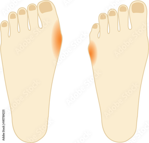 外反母趾と内反小趾のイラストセット