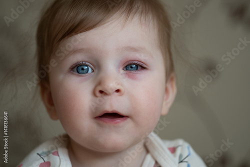 Close up of baby with bacterial purulence conjunctivitis, also known as pink eye. Eye infection.
