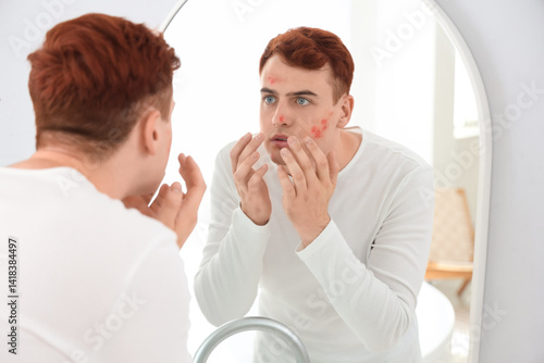 Teenage boy with acne looki...