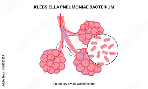Klebsiella pneumoniae poster