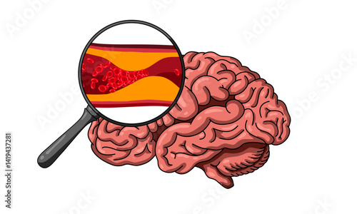 Cholesterol in human blood vessels. Arteriosclerosis, infarct, ischemia, thrombosis disease. blocked vascular, fatty streak, plaque. medical vector illustration.