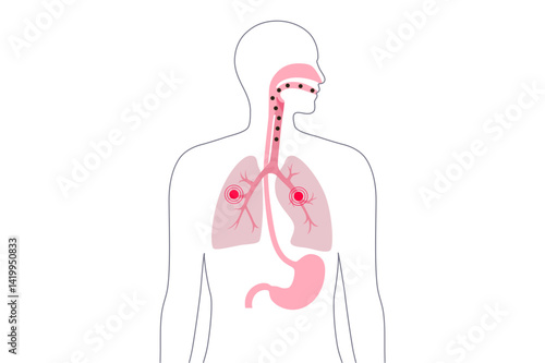 Aspiration pneumonia poster