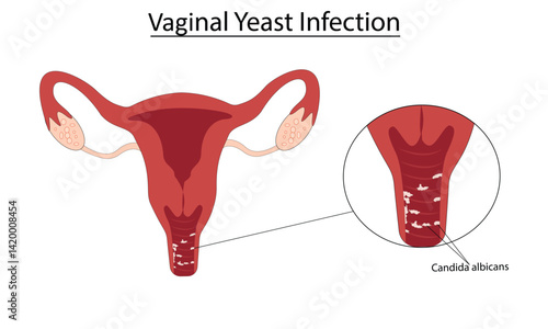 Vaginal yeast infection vector illustration