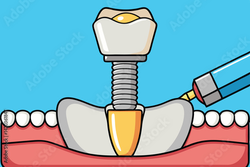 Demonstration of dental implant placement showcasing minimal vector illustration of hand, screw, and jaw with adjacent teeth