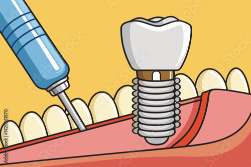 Demonstration of dental implant placement showcasing minimal vector illustration of hand, screw, and jaw with adjacent teeth