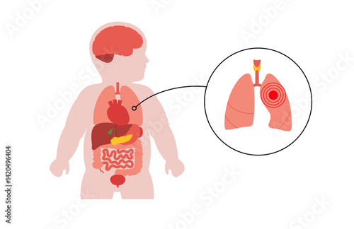 Lung diseases in a child