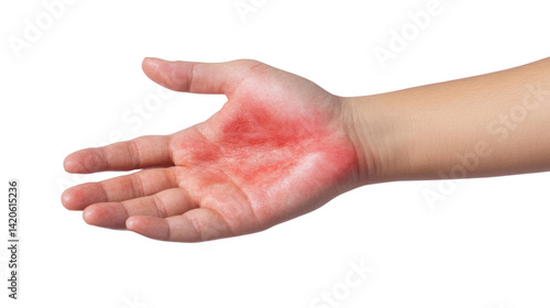 Burn Injury on Palm: This photo captures a close-up view of a hand afflicted with a severe burn, revealing the redness and damage caused by the injury.