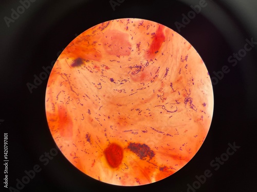 Mixed organism bacteria in sputum gram stain.