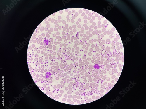 This image shows a blood smear under a microscope, revealing an abnormally high number of platelets. The platelets appear as small, irregularly shaped cell fragments scattered throughout the field. 
