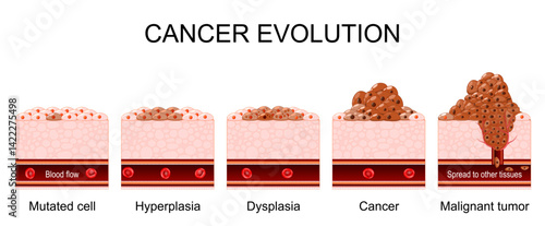 Cancer evolution from Hyperplasia and Mutated cell to Dysplasia, Cancer and Malignant tumor