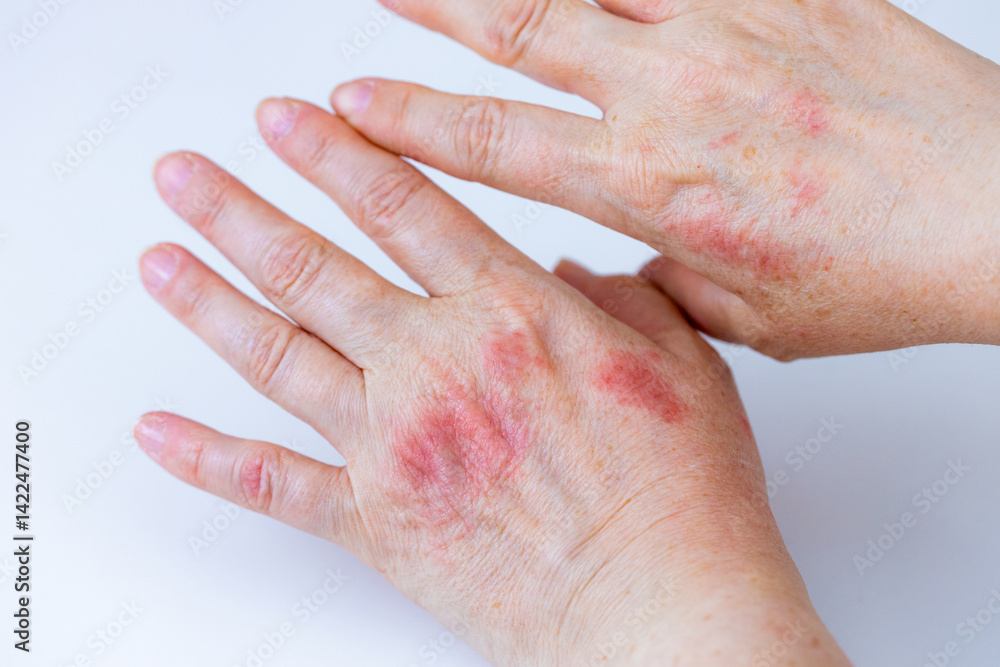 atopic dermatitis. red, itchy, womans hands. Cracked skin and allergic wounds on hands. Medical concept. close up. macro