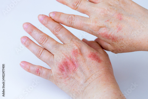 Obraz na płótnie atopic dermatitis. red, itchy, womans hands. Cracked skin and allergic wounds on hands. Medical concept. close up. macro w salonie