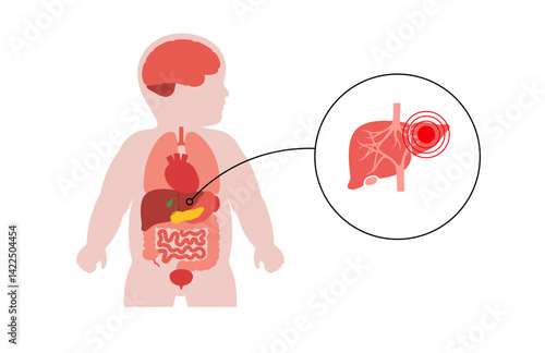 Liver diseases in a child