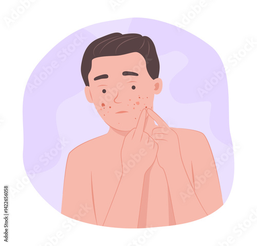 Young Man with Acne and Scar on Face for Dermatological Symptom Concept Illustration Clip Art