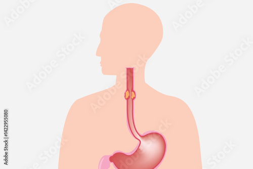  medical illustration. illustration of esophageal cancer. eps 10
