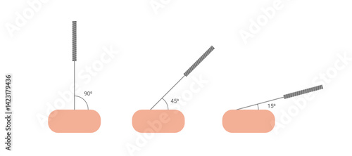 Acupuncture, different angles of acupuncture needle insertion. Alternative medicine. Body therapy and spa, wellness and acupressure. Vector illustration