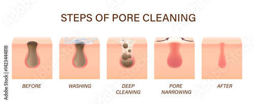 Skin pores cleaning steps for face acne and facial cleanser treatment, vector process. Skin care foam cleaner for blackhead and dirty cells clogged with sebum, pores cleaning infographic for cleanser