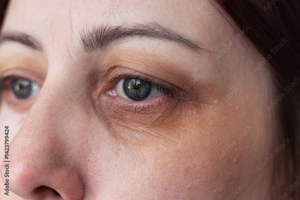 Fototapeta premium Close-up portrait of young caucasian woman's face with big dark pigment spot on the skin around the eye.