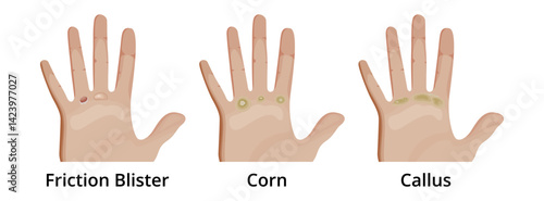 Friction blister, corn and callus forming on hand
