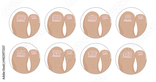 Podiatrist applying different kinds of metallic threads for ingrown toenail correction