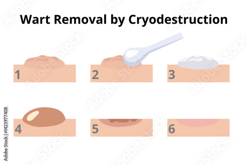 Dermatologist removing wart using cryodestruction procedure in six steps