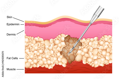 educational cutout diagram of human skin showing the process of Liposuction through lipo fat removal procedure. Healthcare and Medical concept