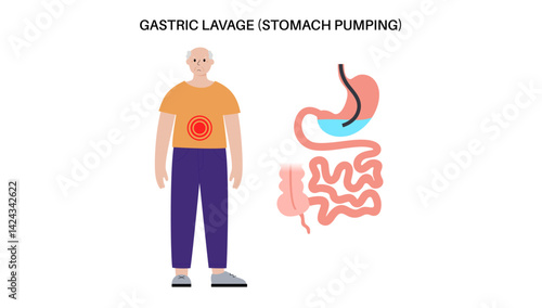 Stomach wash gastric lavage